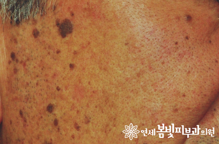 다양한 얼굴 색소 치료 #2 (흑자 없애는법, 검버섯 없애는법) 관련 이미지 3