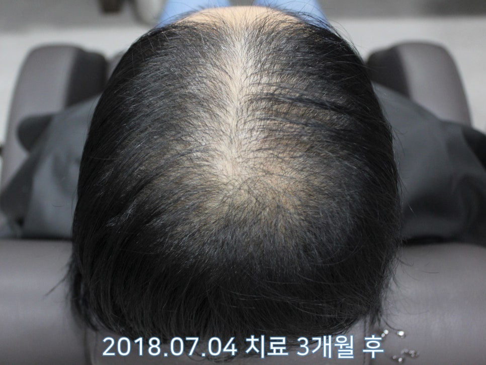 연세봄빛피부과 탈모치료 #21 (여성형탈모, 이마탈모) 관련 이미지 8