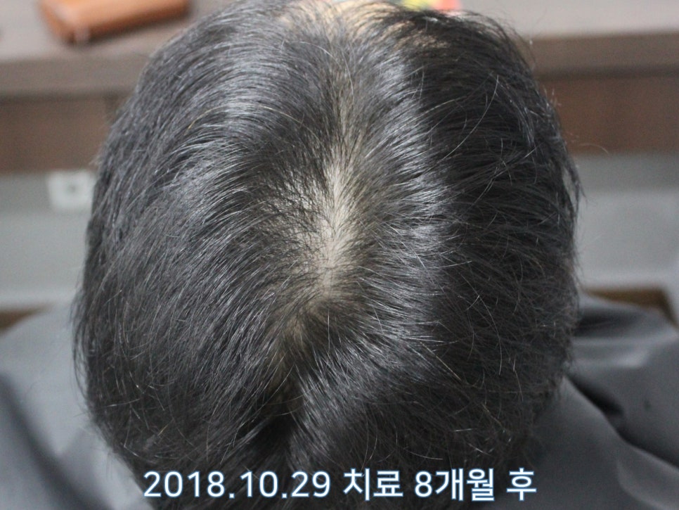 연세봄빛피부과 탈모치료 #18 (남성형탈모, 이마탈모, 정수리탈모, 모발이식 후 치료) 관련 이미지 7