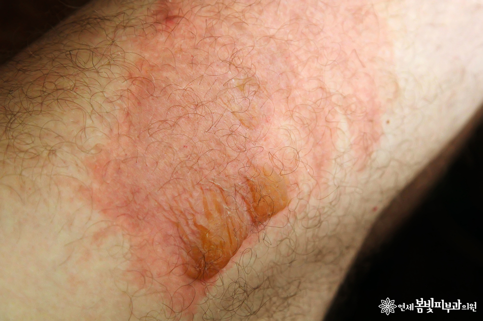 화상, 화상치료, 화상흉터치료 잘 하는 법 (화상병원, 화상피부과) 관련 이미지 3