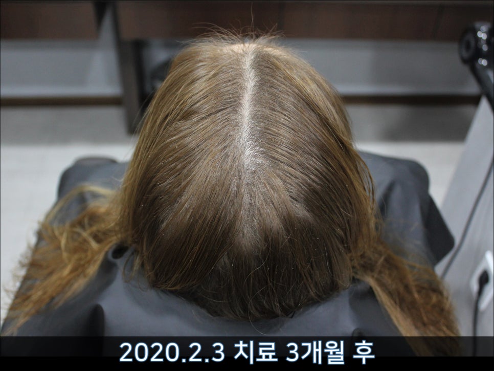 연세봄빛피부과 탈모치료 #40 (여성형탈모, 외국인의 경우) 관련 이미지 2