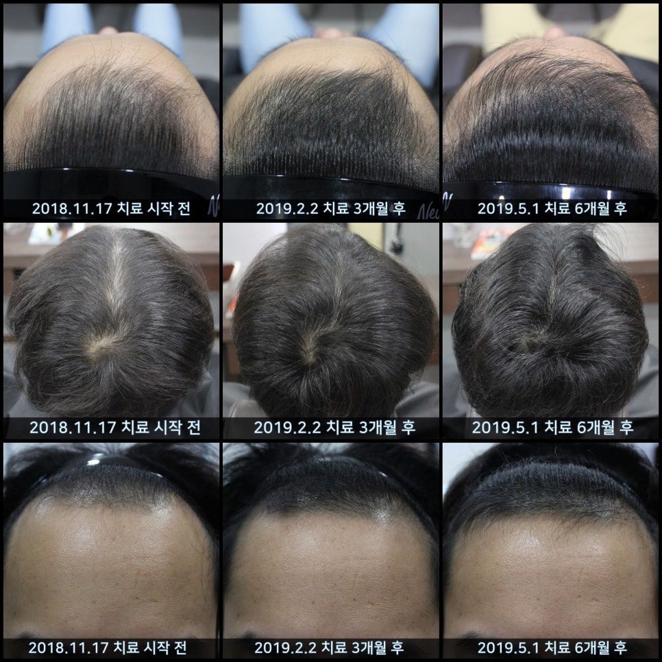 연세봄빛피부과 탈모치료 #33 (남성형탈모, 이마탈모, 정수리탈모, 가족력없음) 관련 이미지 10