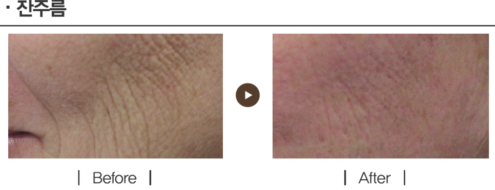 리프팅 레이저의 새로운 강자, 울트라스킨 플러스 도입 관련 이미지 9