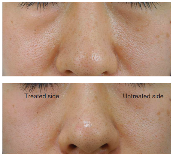 모공줄이는 방법 #1 (모공이 생기는 원인, 분류, 블랙헤드, 화이트헤드, 아쿠아필, 제네시스 레이저) 관련 이미지 8