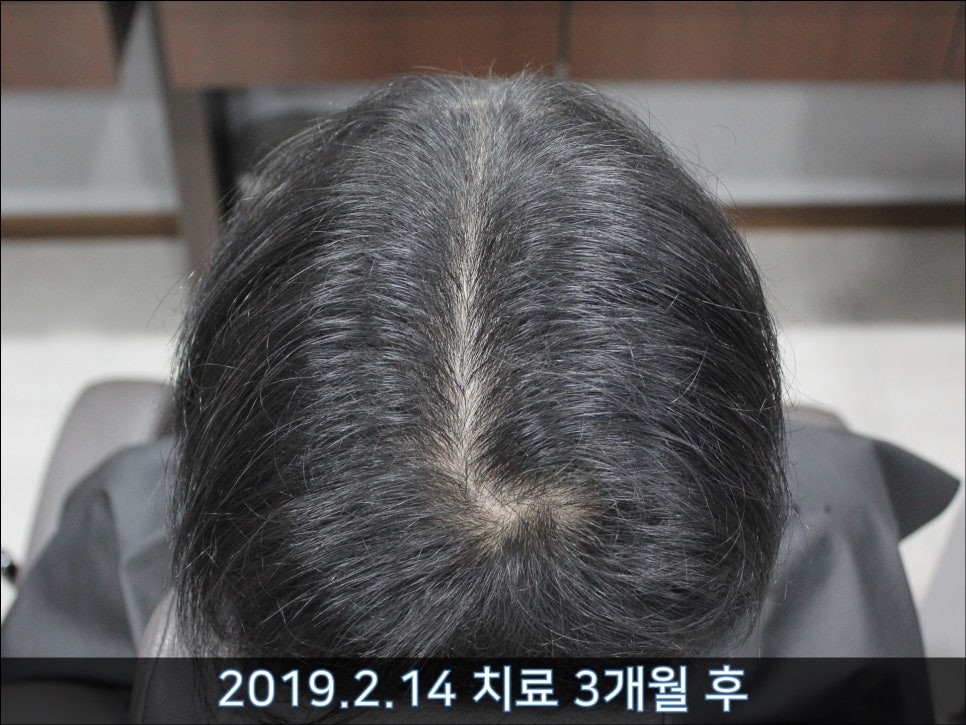 연세봄빛피부과 탈모치료 #35 (남성형탈모, 이마탈모, 가족력없음) 관련 이미지 6