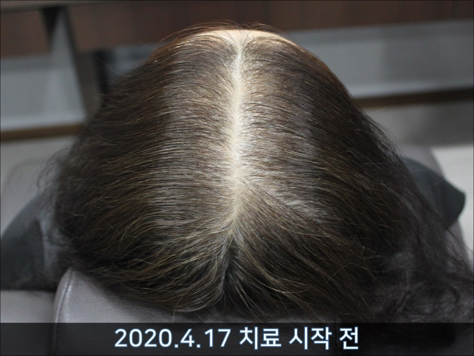 연세봄빛피부과 탈모치료 #45 (AI를 이용한 탈모 치료 성과 분석) 관련 이미지 2