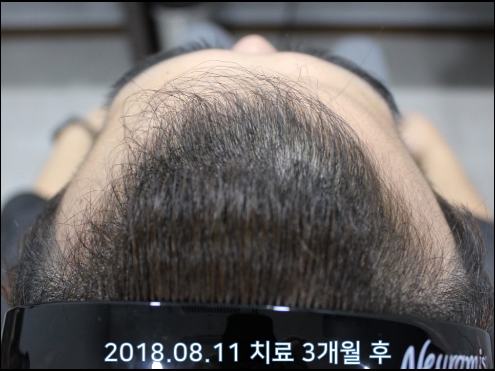 연세봄빛피부과 탈모치료 #23 (남성형탈모, 이마탈모, 정수리탈모) 관련 이미지 5