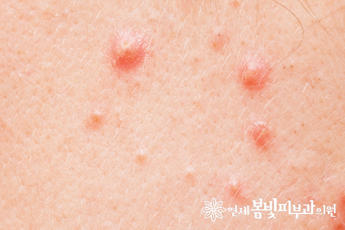 여드름 패치 안전하게 사용하기 관련 이미지 4