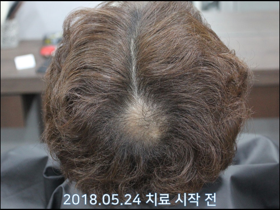연세봄빛피부과 탈모치료 #23 (남성형탈모, 이마탈모, 정수리탈모) 관련 이미지 1