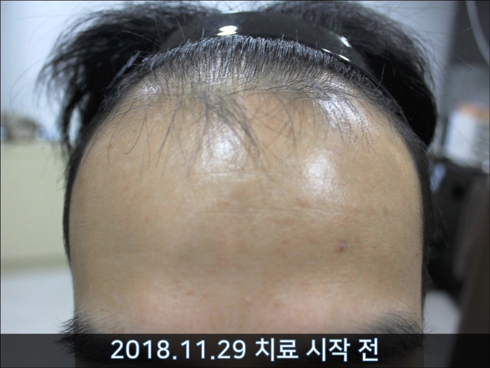 연세봄빛피부과 탈모치료 #35 (남성형탈모, 이마탈모, 가족력없음) 관련 이미지 3