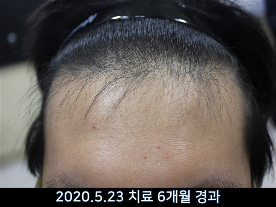 연세봄빛피부과 탈모치료 #43 (정수리탈모, F형 탈모) 관련 이미지 9