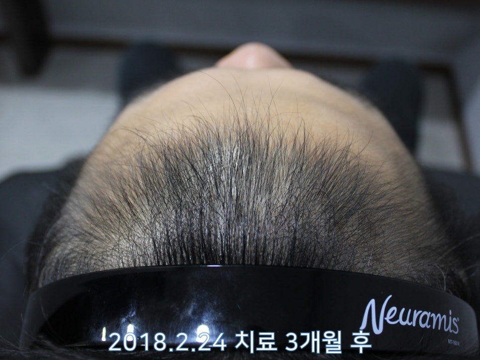 연세봄빛피부과 탈모치료 #8 (남성형탈모, 이마탈모, 정수리탈모) 관련 이미지 2