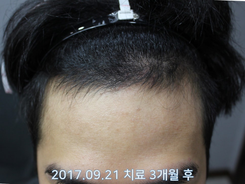 연세봄빛피부과 탈모치료 #14 (남성형탈모, 이마탈모) 관련 이미지 4