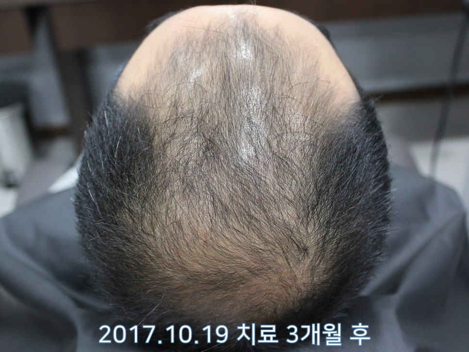 연세봄빛피부과 탈모치료 #9 (남성형탈모, 이마탈모, 정수리탈모) 관련 이미지 5