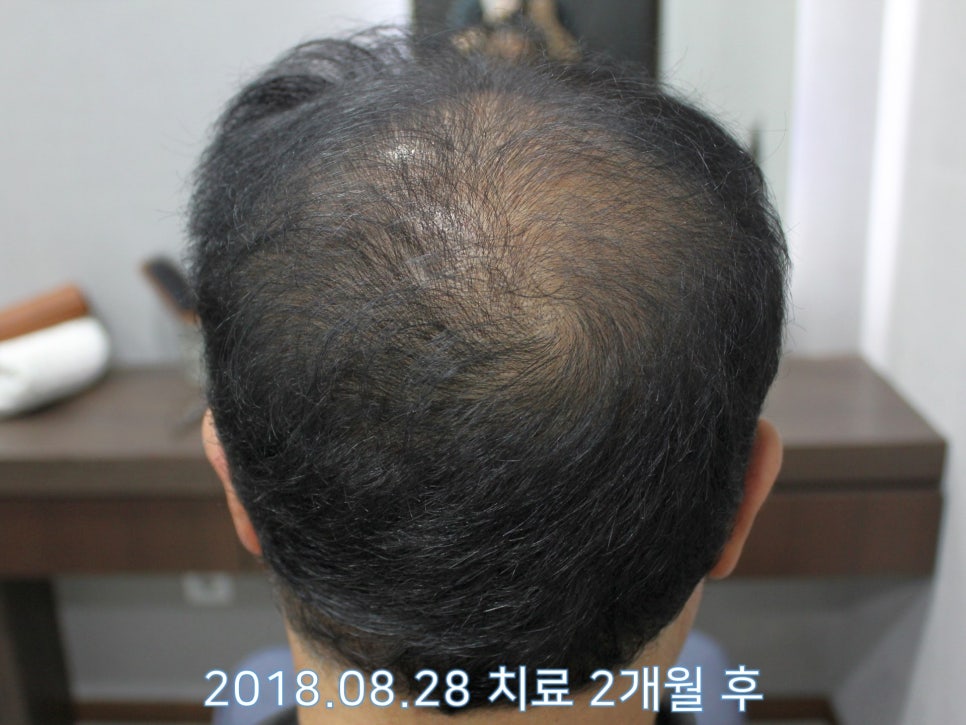 연세봄빛피부과 탈모치료 #16 (남성형탈모, 이마탈모, 정수리탈모, 3단계) 관련 이미지 5