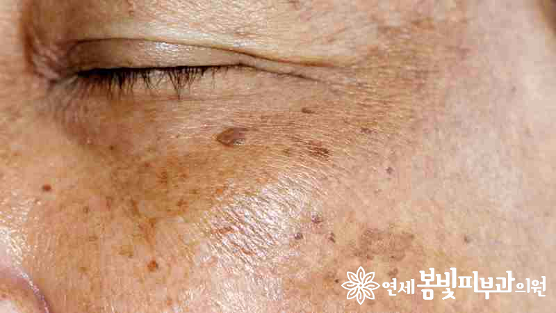 짙은 색소만 골라서 빠르게 공략~ 마이크로 토닝! 관련 이미지 2