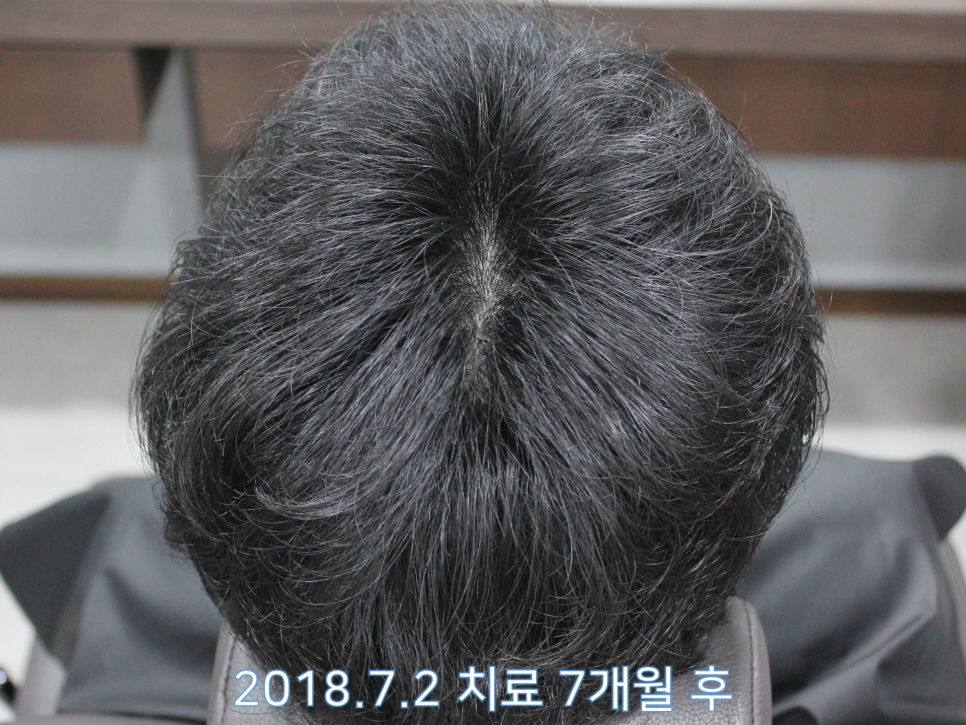 연세봄빛피부과 탈모치료 #13 (남성형탈모, 이마탈모) 관련 이미지 6