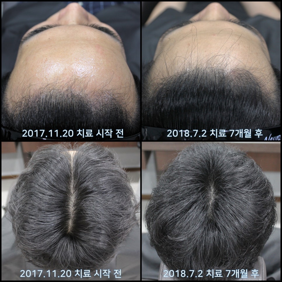 연세봄빛피부과 탈모치료 #13 (남성형탈모, 이마탈모) 관련 이미지 7