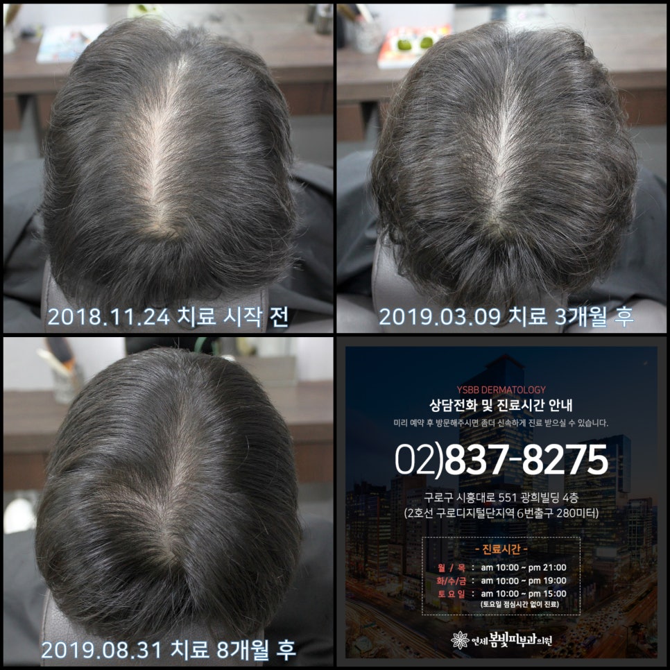 연세봄빛피부과 탈모치료 #28 (남성형탈모, 정수리탈모) 관련 이미지 6