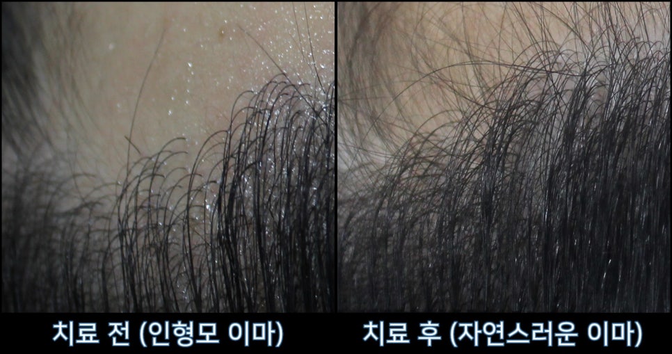 연세봄빛피부과 탈모치료 #18 (남성형탈모, 이마탈모, 정수리탈모, 모발이식 후 치료) 관련 이미지 4