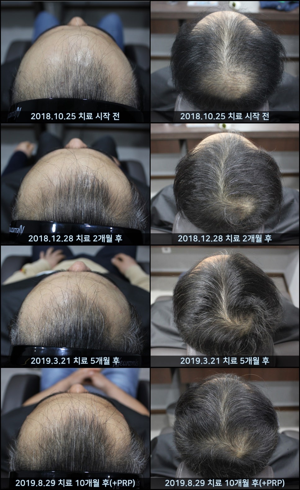 연세봄빛피부과 탈모치료 #30 (남성형탈모, 이마탈모, 정수리탈모) 관련 이미지 9