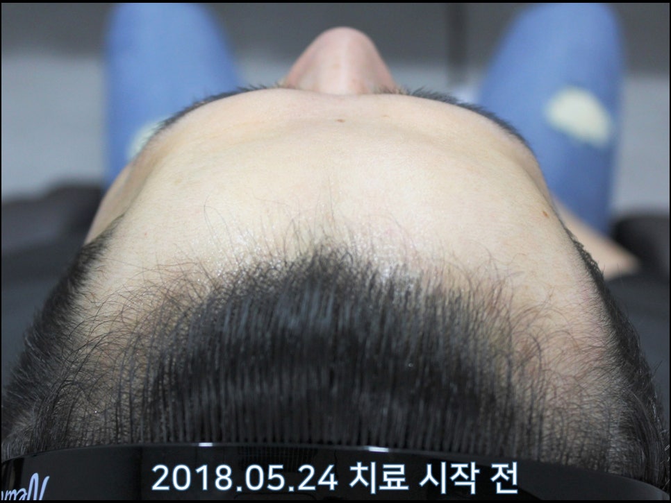 연세봄빛피부과 탈모치료 #22 (남성형탈모, 이마탈모) 관련 이미지 1