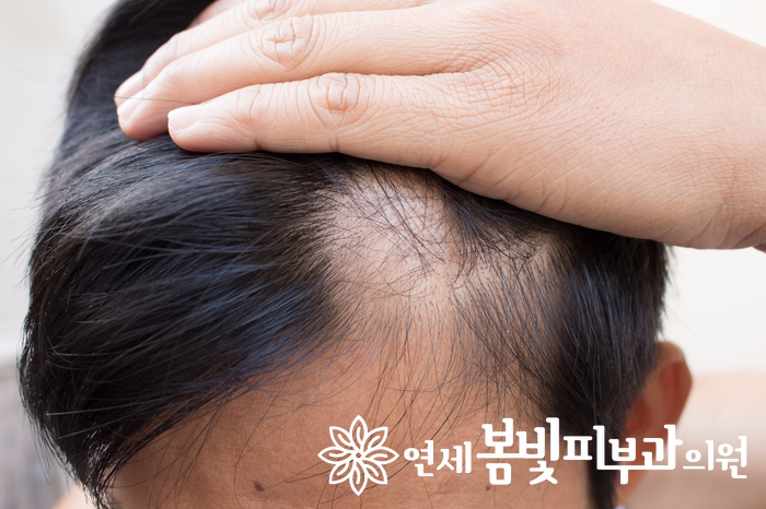 가을이면 술술 빠지는 머리, 탈모의 시작일까요? 관련 이미지 3