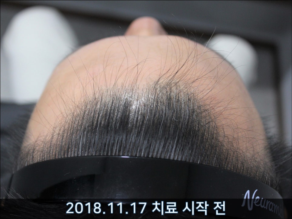 연세봄빛피부과 탈모치료 #31 (탈모와 모자 착용, 남성형탈모, 이마탈모, 정수리탈모) 관련 이미지 3