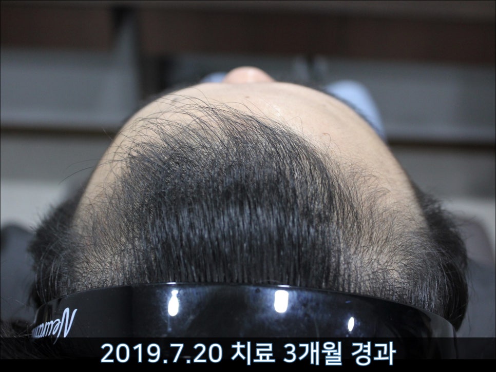 연세봄빛피부과 탈모치료 #42 (남성형탈모,M자탈모) 관련 이미지 3