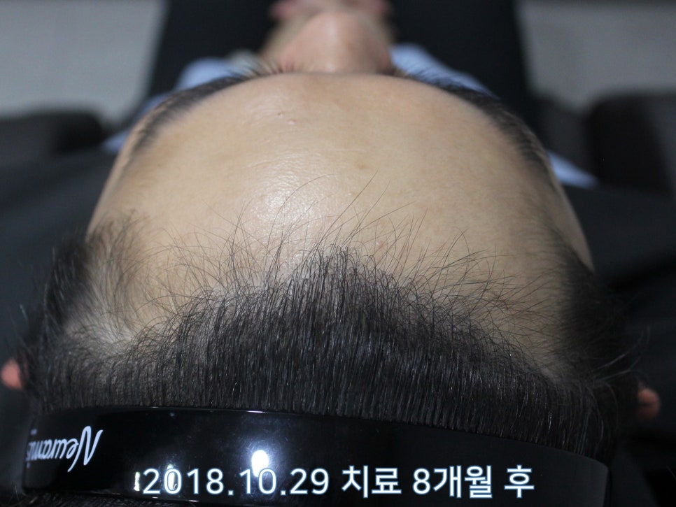 연세봄빛피부과 탈모치료 #18 (남성형탈모, 이마탈모, 정수리탈모, 모발이식 후 치료) 관련 이미지 3