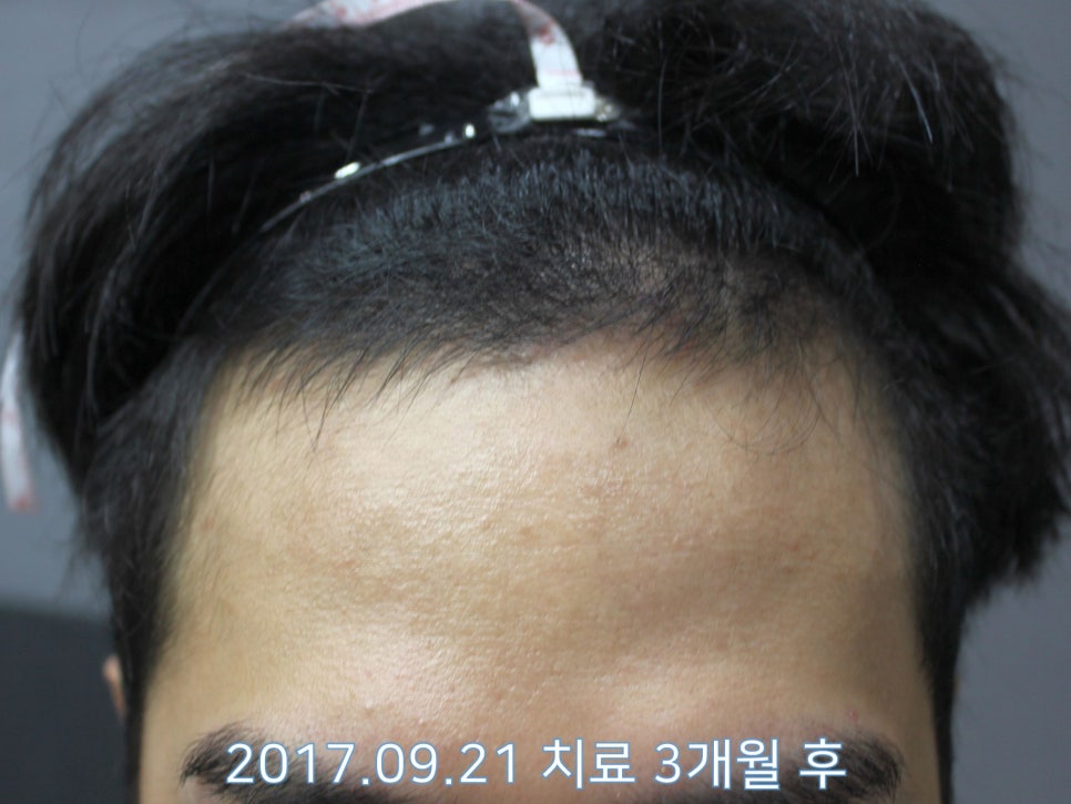 연세봄빛피부과 탈모치료 #14 (남성형탈모, 이마탈모) 관련 이미지 2