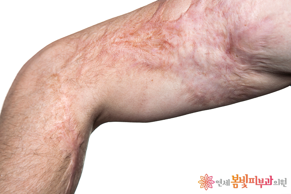 겨울철 난방기 사용 주의 #1 저온화상 (온수매트, 전기장판, 전기매트, 전기요) 관련 이미지 4