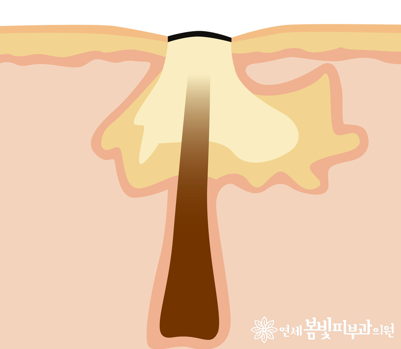 미세먼지가 악화시킬 수 있는 피부 질환 (아토피, 모공, 여드름, 탈모) 관련 이미지 2