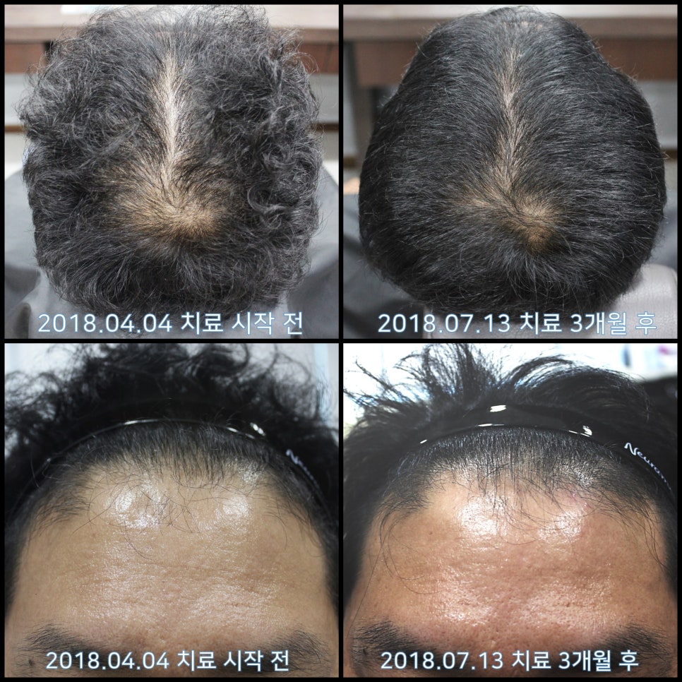 연세봄빛피부과 탈모치료 #20 (남성형탈모, 정수리탈모, 헤어스타일) 관련 이미지 5