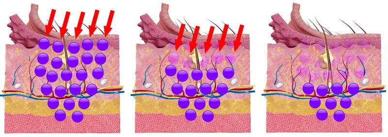 다크써클 없애는법 #3 (다크써클 치료: 레이저 치료, 색소 레이저, 레이저 토닝, 혈관 레이저, 탄력 레이저, 하이푸) 관련 이미지 2