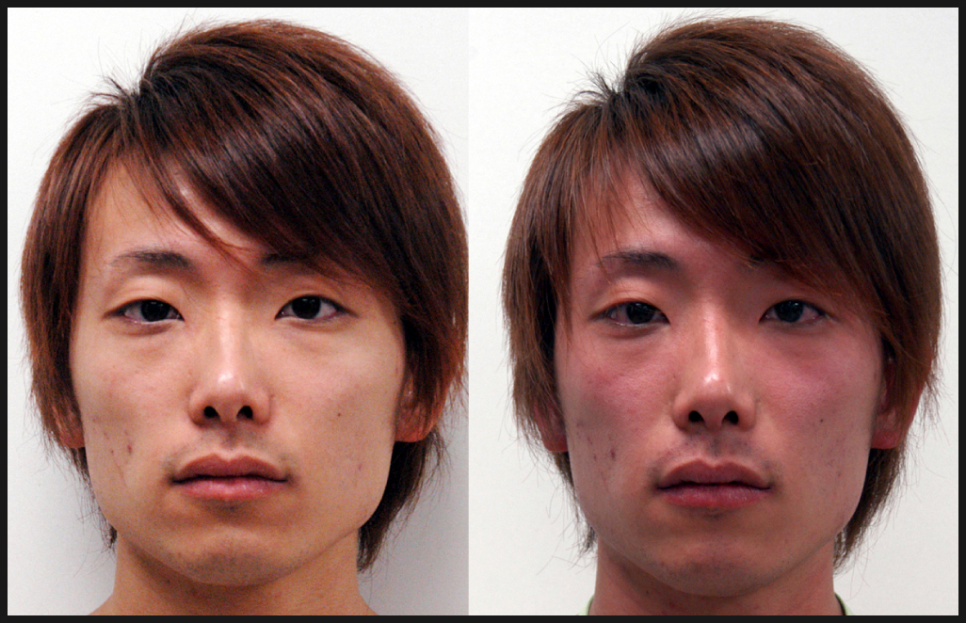 안면홍조 없애는법 #1 (안면홍조원인, 안면홍조증상) 관련 이미지 1