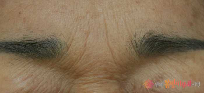 보톡스 바르게 알기 #3 (보톡스 맞고 예뻐지기, 보톡스 시술이 가능한 부위, 이마 주름, 미간 주름, 눈가 주름, 눈밑 주름, 콧잔등 주름, 입가 주름, 사각턱, 종아리, 윤곽술 관련 이미지 3