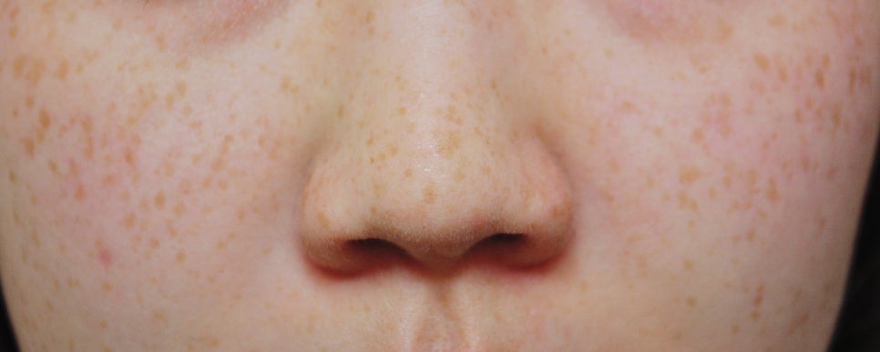 다양한 얼굴 색소 치료 #1 (점없애는법, 주근깨 없애는법) 관련 이미지 3