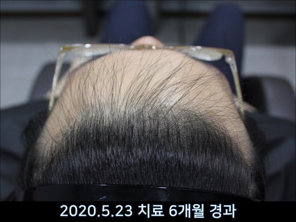 연세봄빛피부과 탈모치료 #43 (정수리탈모, F형 탈모) 관련 이미지 6