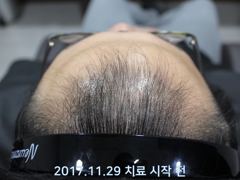 연세봄빛피부과 탈모치료 #8 (남성형탈모, 이마탈모, 정수리탈모) 관련 이미지 1