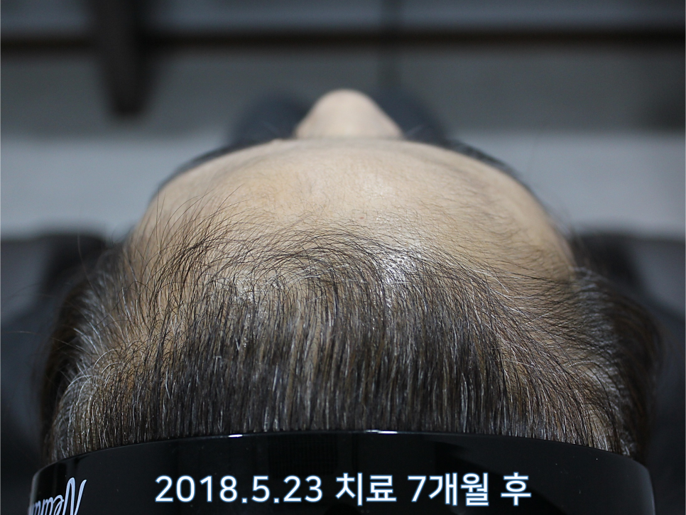 연세봄빛피부과 탈모치료 #6 (여성형탈모, 정수리탈모) 관련 이미지 6