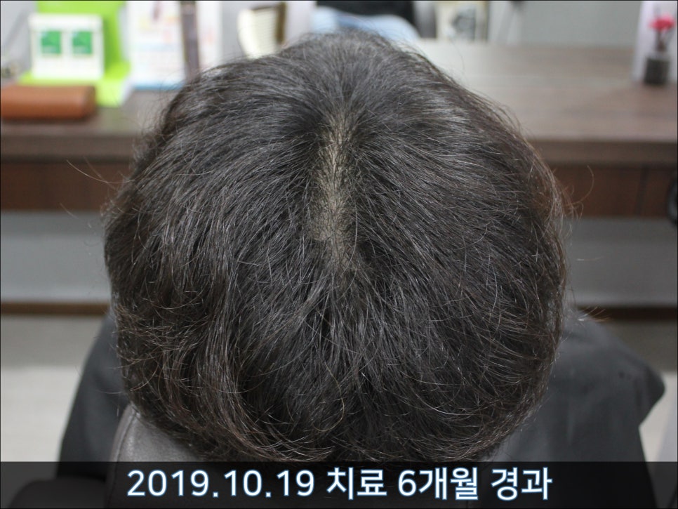 연세봄빛피부과 탈모치료 #42 (남성형탈모,M자탈모) 관련 이미지 12