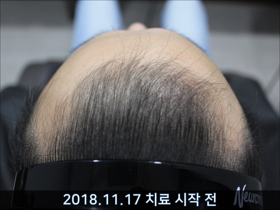 연세봄빛피부과 탈모치료 #33 (남성형탈모, 이마탈모, 정수리탈모, 가족력없음) 관련 이미지 1