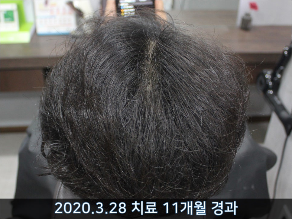 연세봄빛피부과 탈모치료 #42 (남성형탈모,M자탈모) 관련 이미지 13