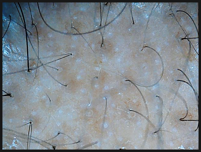 연세봄빛피부과 탈모치료 예시 (남성형탈모, 정수리탈모) 관련 이미지 2