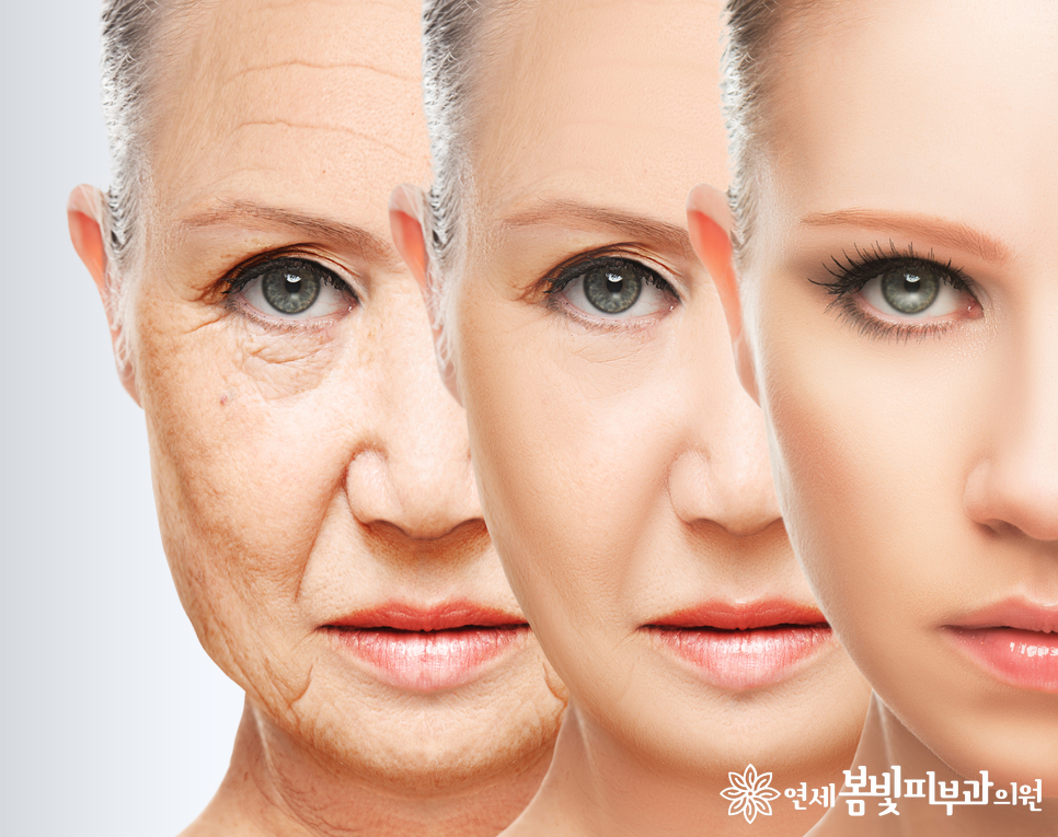 동안필러 치료 예시 #1,2 (앞광대필러, 눈물도랑필러, 볼꺼짐필러) 관련 이미지 1