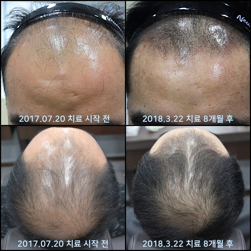 연세봄빛피부과 탈모치료 #9 (남성형탈모, 이마탈모, 정수리탈모) 관련 이미지 7