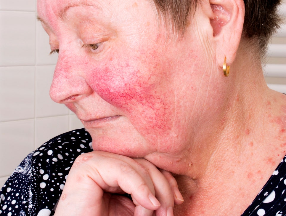 주사(주사비, 딸기코, 성인여드름, 모세혈관확장증, 얼굴홍조증, Rosacea) 관련 이미지 1