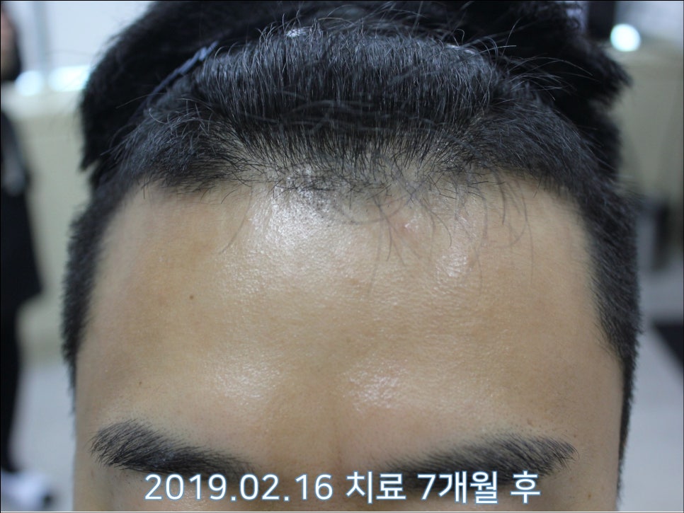 연세봄빛피부과 탈모치료 #27 (남성형탈모, 이마탈모 정수리탈모) 관련 이미지 3