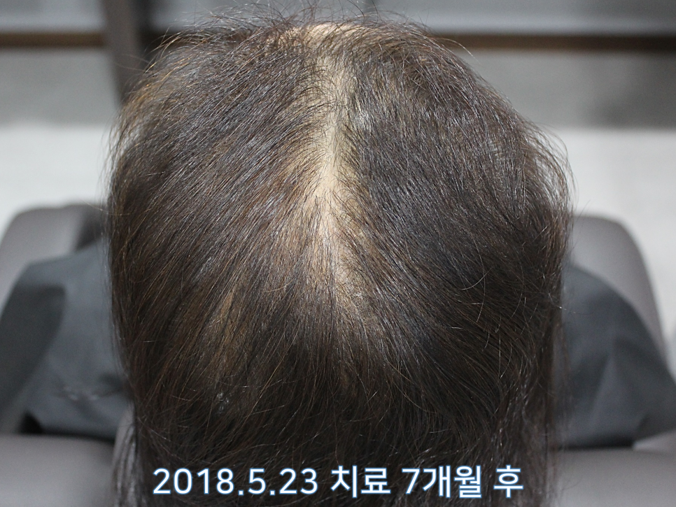 연세봄빛피부과 탈모치료 #6 (여성형탈모, 정수리탈모) 관련 이미지 3